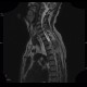 Pancoust tumor, extension into spine, lung cancer, pulmonary carcinoma: MRI - Magnetic Resonance Imaging